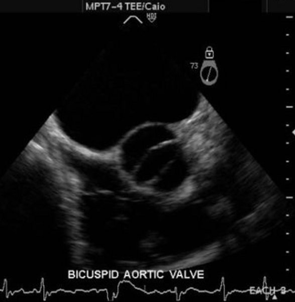 Bicuspid Aortic Valve Aorta