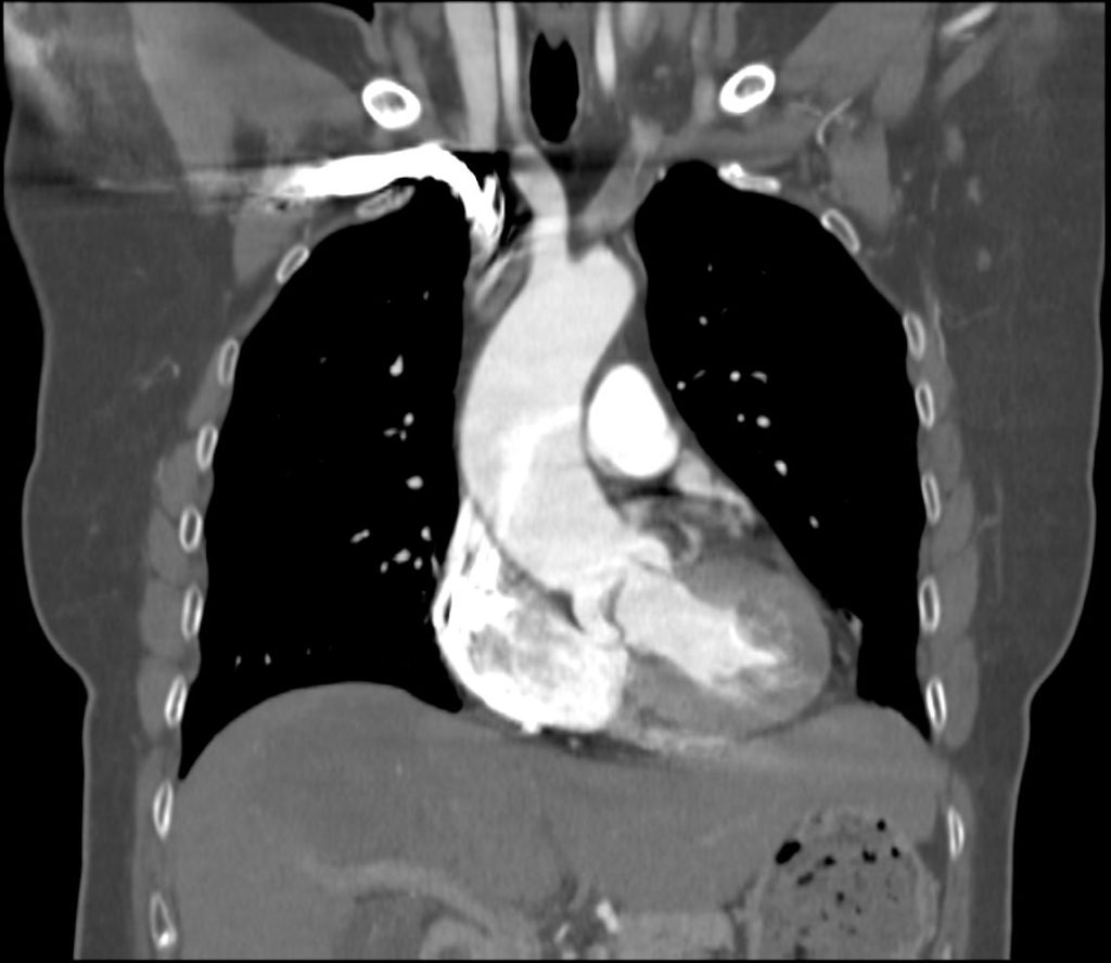 aortic-stenosis-aorta